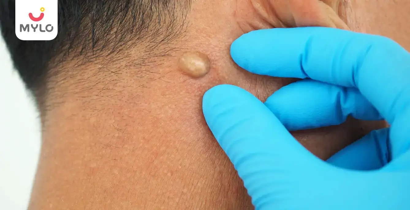 Images related to গ্যাংলিয়ন সিস্ট কী? এর কারণ, চিকিৎসা ও উপসর্গ