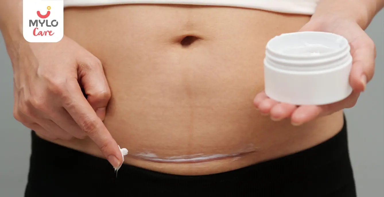 ಸಿ-ಸೆಕ್ಷನ್ ಸ್ಕಾರ್ ವರ್ಷಗಳ ನಂತರ ಏಕೆ ಹರ್ಟ್ ಮಾಡುತ್ತದೆ  ರಲ್ಲಿ ನೀವು ಅದರ ಬಗ್ಗೆ ಏನು ಮಾಡಬಹುದು | Why Does C-Section Scar Hurt Years Later & What You Can Do About It in Kannada?