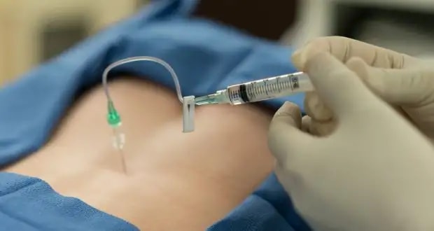 Images related to क्या एपिड्यूरल लेना माँ और शिशु के लिए खतरनाक है?  जानिए यह प्रसव के दौरान किस स्टेज में दिया जाता है? 