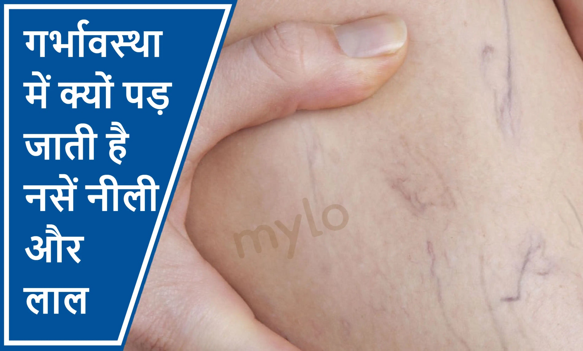 गर्भावस्था के दौरान Spider Veins होना 