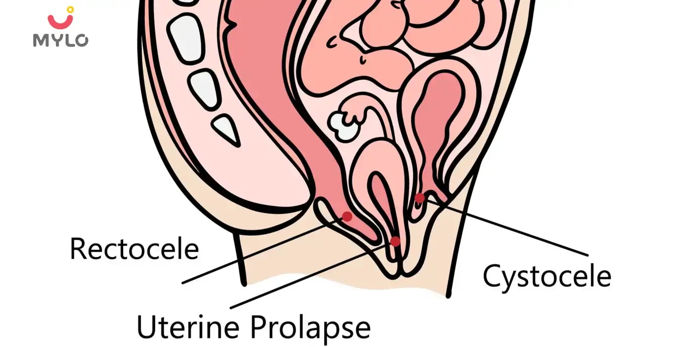 సిస్టోసెల్: కారణాలు, లక్షణాలు & చికిత్స  (What is Cystocele : Reason and Treatment in Telugu)