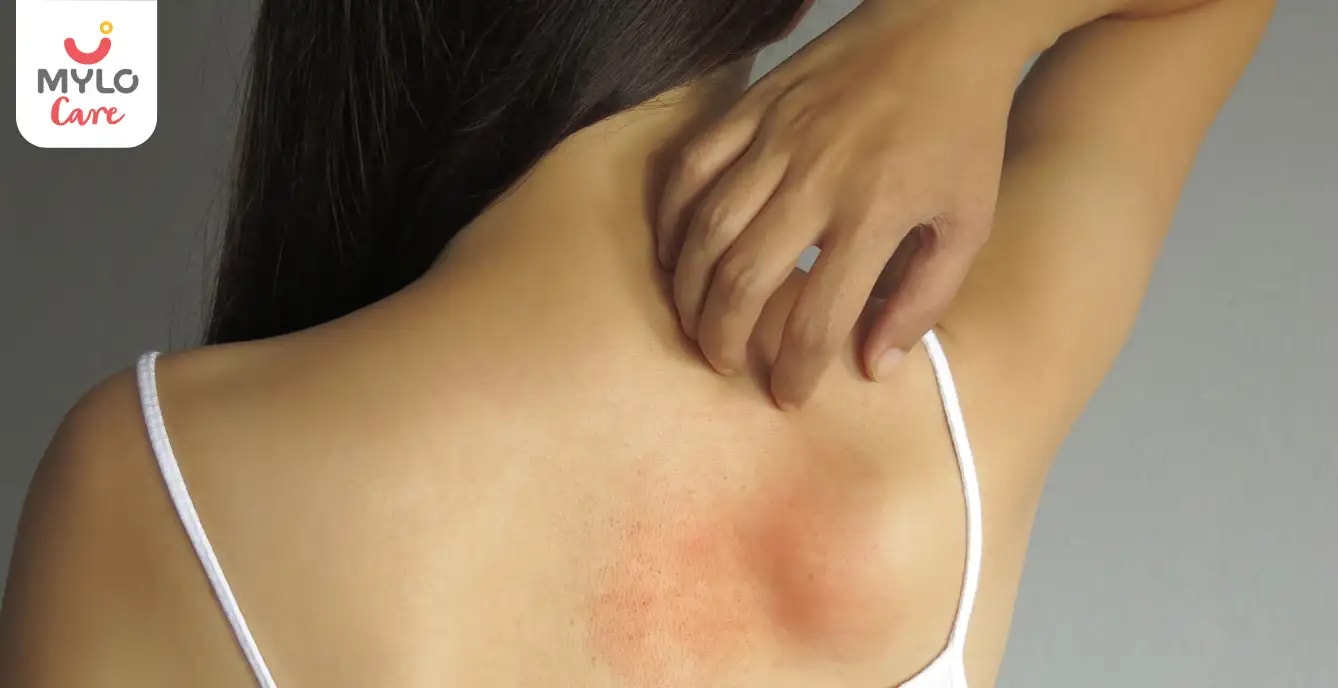 Images related to கர்ப்ப காலத்தில் வெப்ப அரிப்பு : காரணங்கள், அறிகுறிகள் மற்றும் தடுப்பு I Heat Rash During Pregnancy: Causes, Symptoms and Prevention in Tamil   