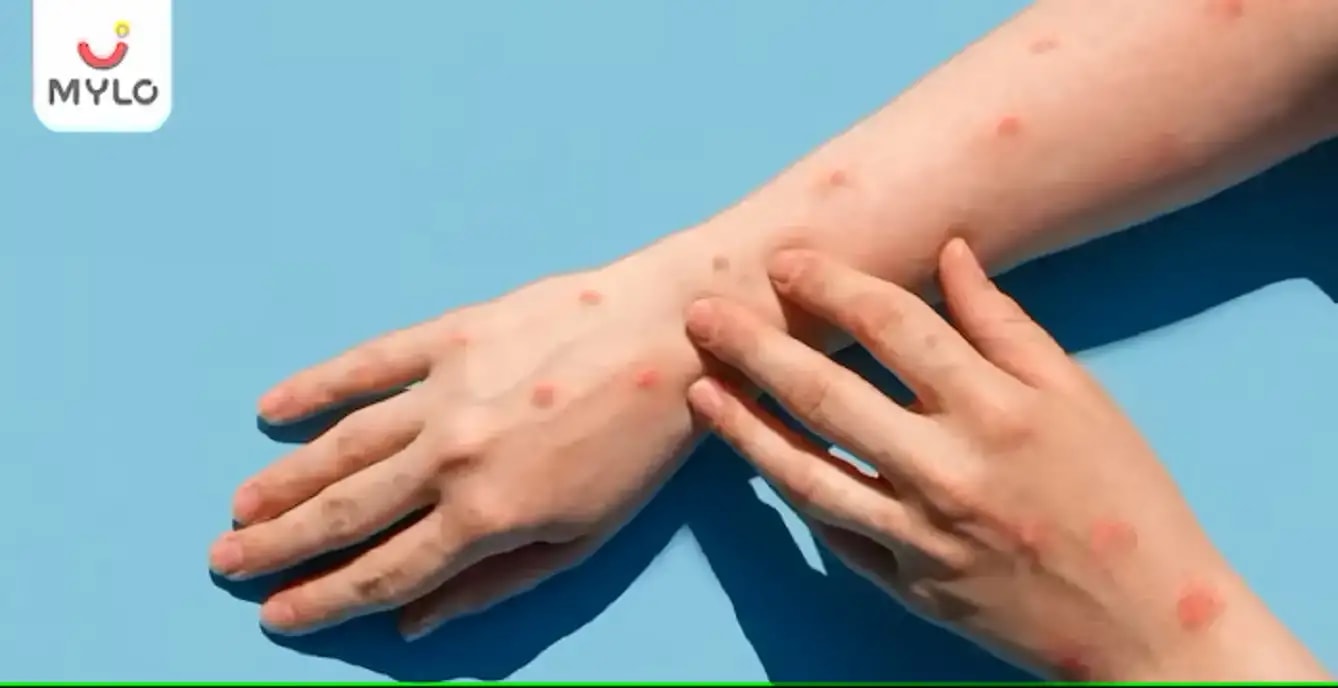 கர்ப்பத்தின் போது தோல் அலர்ஜி(ப்ரூரிகோ): காரணங்கள், அறிகுறிகள் & சிகிச்சை(Prurigo of Pregnancy: Causes, Symptoms & Treatment In Tamil)