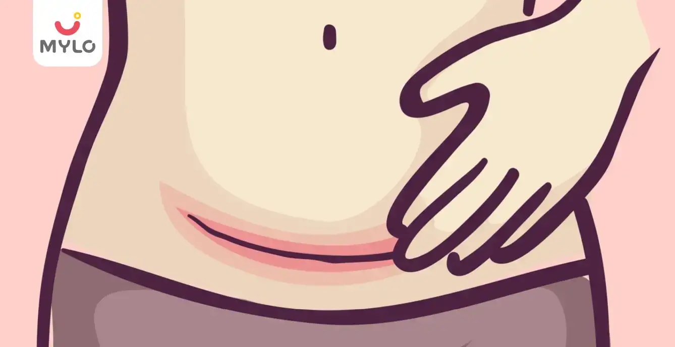 Images related to সি-সেকশনের পর কখন যৌনমিলন করা উচিত?