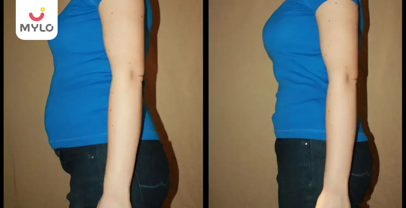 பிரசவத்திற்கு பிறகு தொப்பை கொழுப்பை இயற்கையான முறையில் குறைப்பது எப்படி?