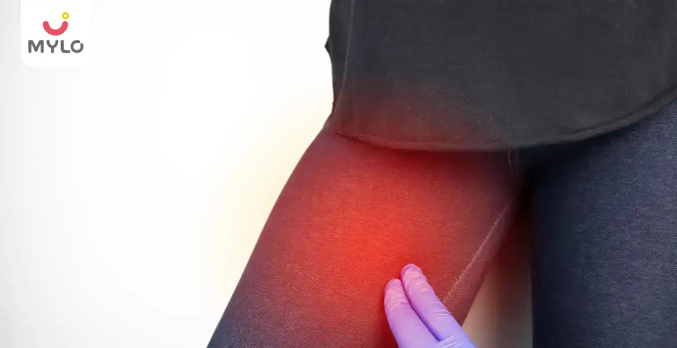 Images related to తొడ పగుళ్లు: లక్షణాలు, కారణాలు మరియు కనిపించే తీరు | Thigh Chafing: Symptoms, Causes & Presentations in Telugu