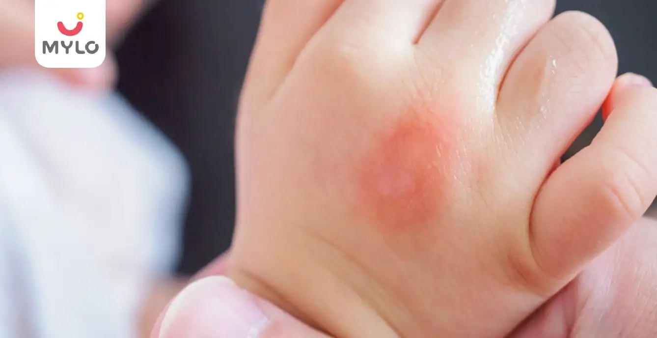 Images related to মশারা বাচ্চাদের দিকেই বেশি আকর্ষিত হয় কেন?