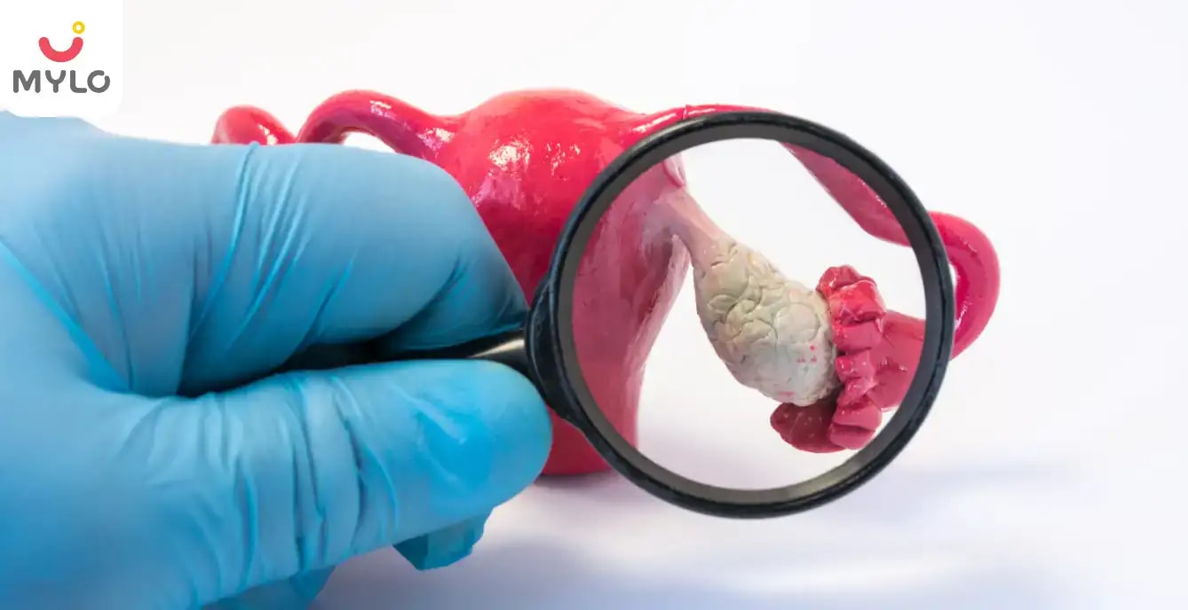 Images related to ওভারিয়ান সিস্ট: প্রকার, কারণ, উপসর্গ এবং চিকিৎসা 