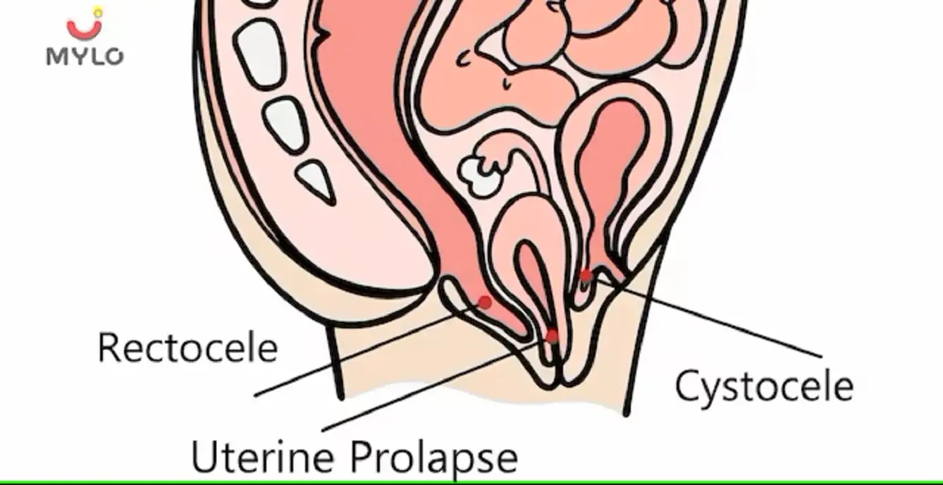 சிஸ்டோசெல்: காரணங்கள், அறிகுறிகள் மற்றும் சிகிச்சை(Cystocele: Causes, Symptoms & Treatment  In Tamil)