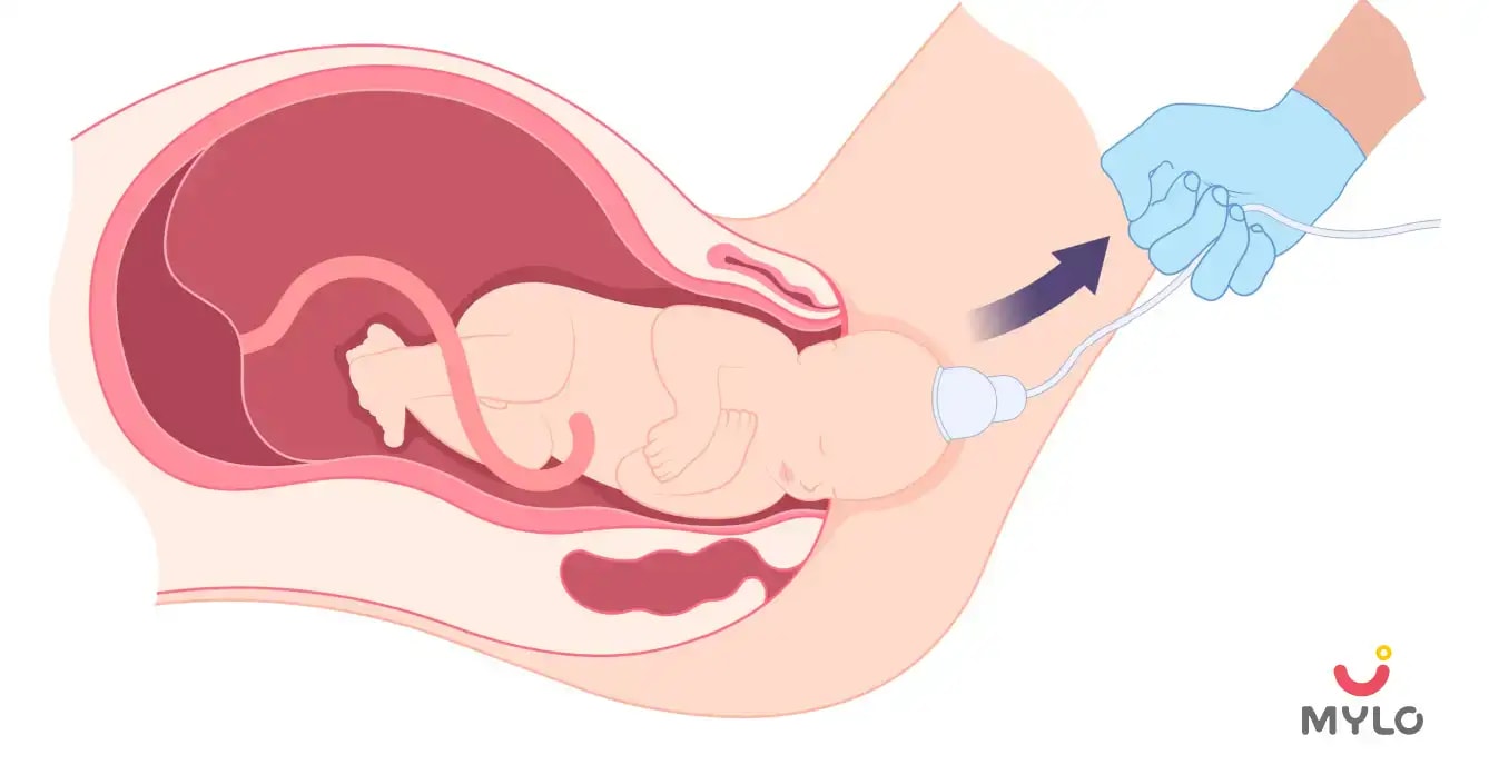 ভ্যাকুয়াম ডেলিভারি সম্পর্কে গর্ভবতী মহিলাদের যা জানা উচিত