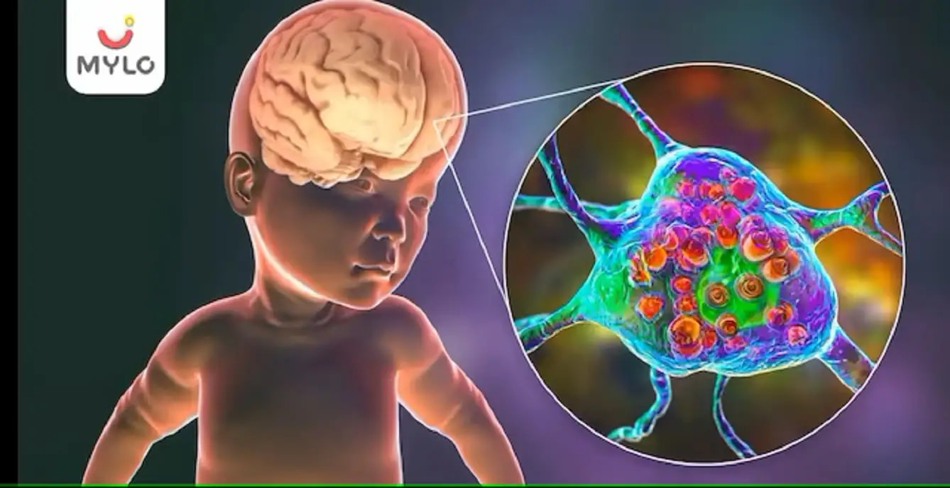   டே சாக்ஸ் நோய்(Tay Sachs): காரணங்கள், அறிகுறிகள், ஆபத்துகள் மற்றும் சிகிச்சை(Tay Sachs Disease: Causes, Symptoms, Risks & Treatment In Tamil)