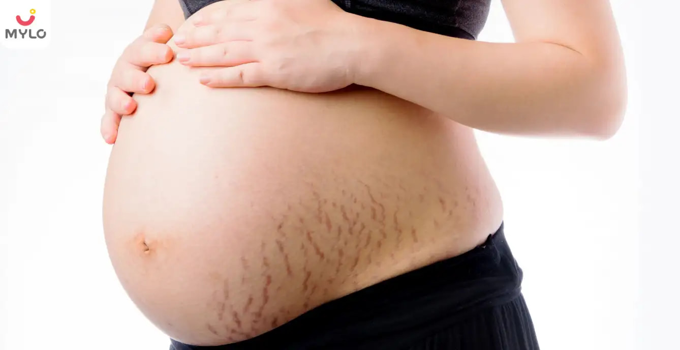 Stretch Marks During Pregnancy in Hindi | स्ट्रेच मार्क्स से परेशान? करें इन बातों पर ग़ौर