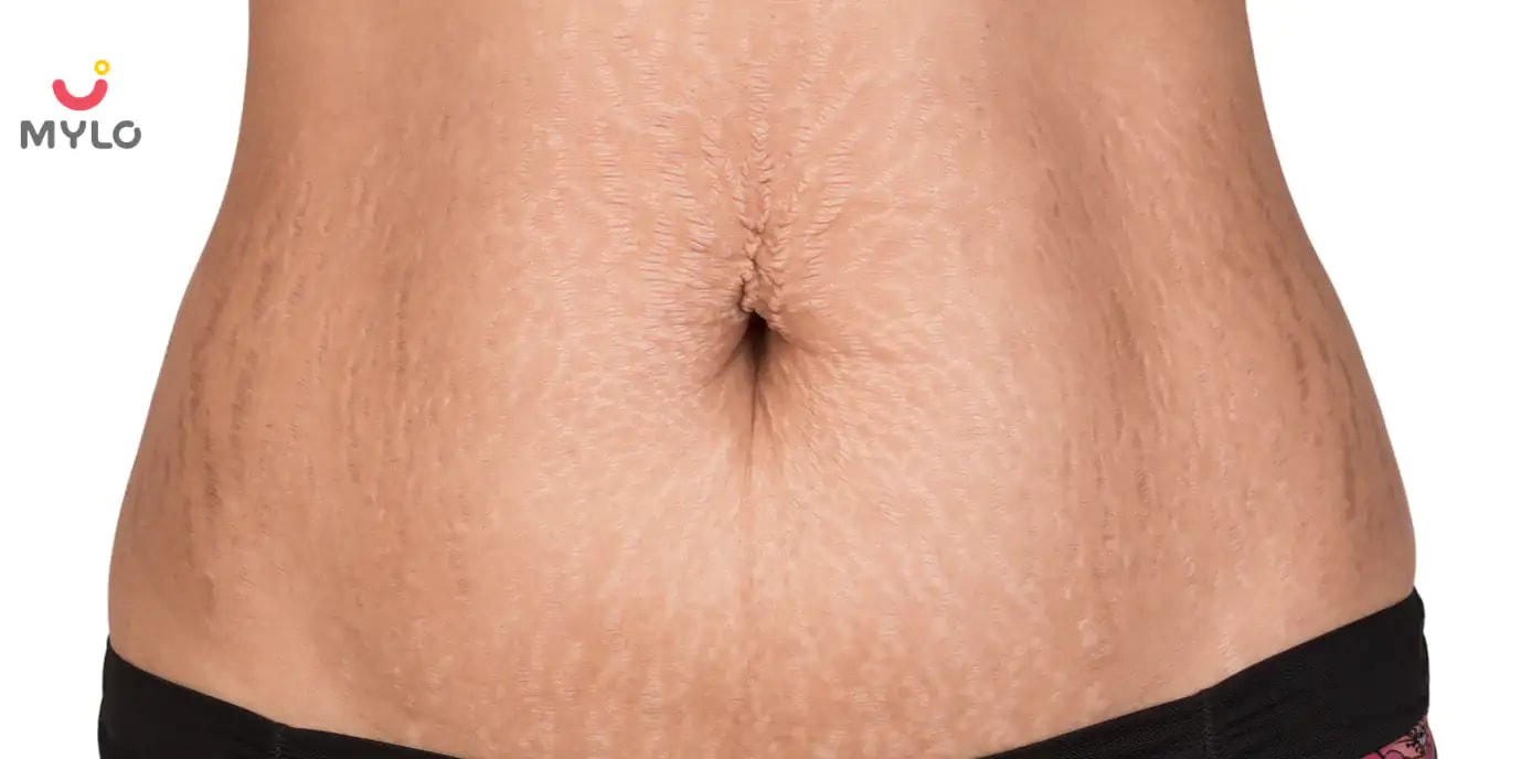 Images related to স্ট্রেচ মার্কস: এগুলি কেন হয় আর এর থেকে কীভাবে মুক্তি পাবেন? [সম্পূর্ণ গাইড]