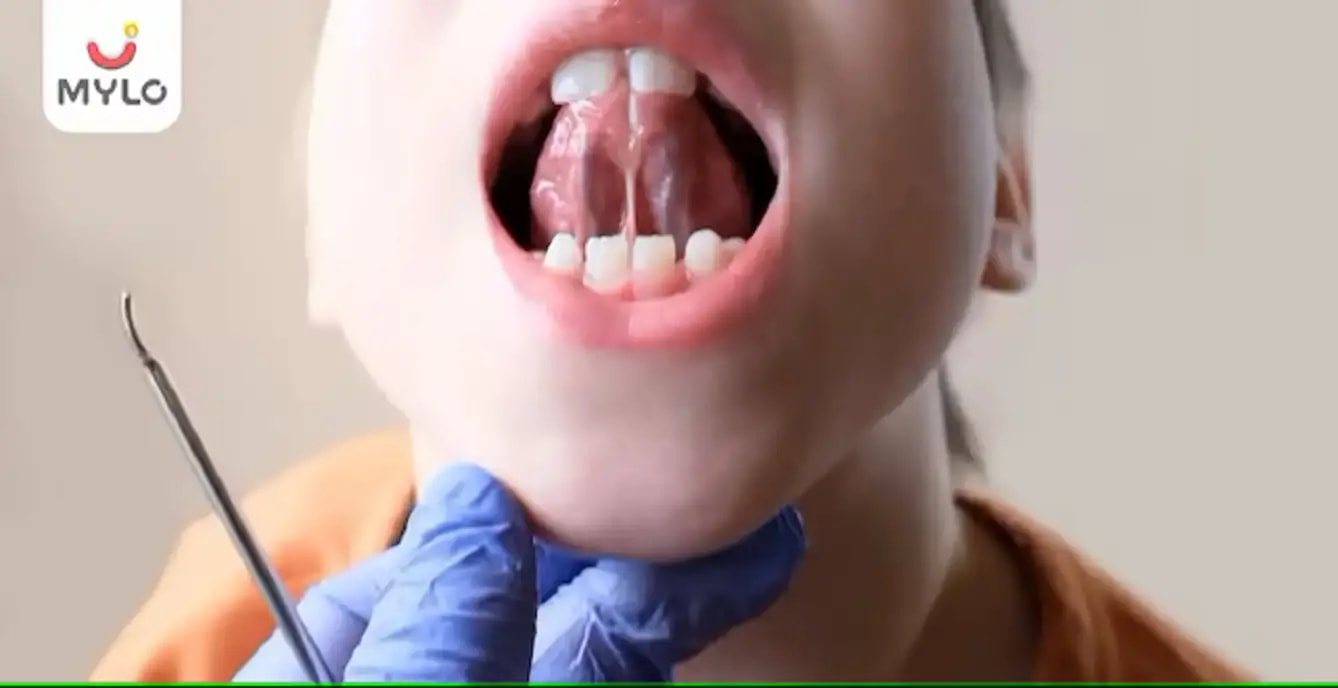 நாக்கு டை(நாக்கு கட்டு): பொருள், அறிகுறிகள் & காரணங்கள் (Tongue Tie: Meaning, Symptoms & Causes  In Tamil)