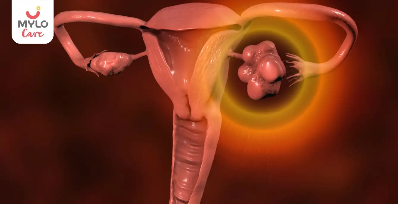 পলিসিস্টিক ওভারিয়ান ডিজিজ (PCOD): কারণ, প্রভাব এবং মোকাবিলার কৌশল | Polycystic Ovarian Disease (PCOD): Navigating Causes, Effects, and Coping Strategies in Bengali