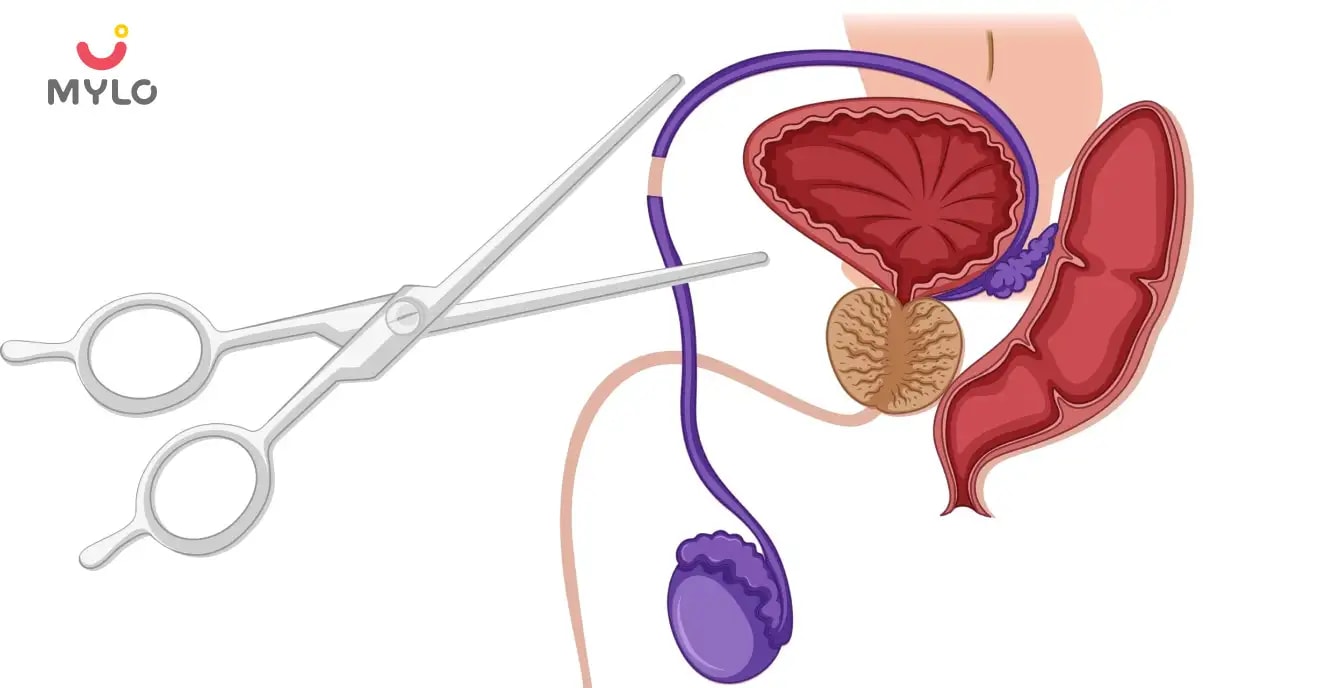 ভ্যাসেকটমি রিভার্সাল: অর্থ এবং ঝুঁকি | Vasectomy Reversal: Meaning And Risks in Bengali