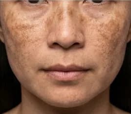 Chloasma (dark facial patches)