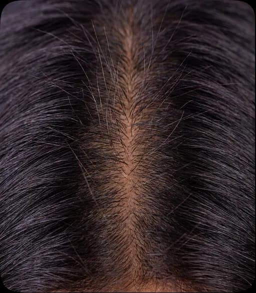 Scalp on day 56