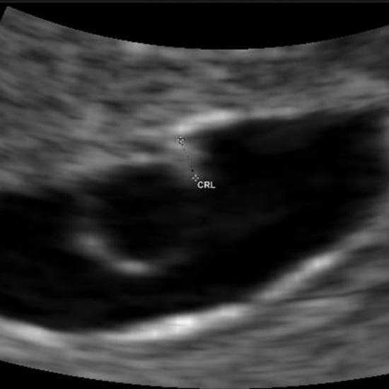 Your Ultrasound in Week 5