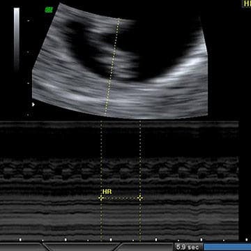 Your Ultrasound in Week 6