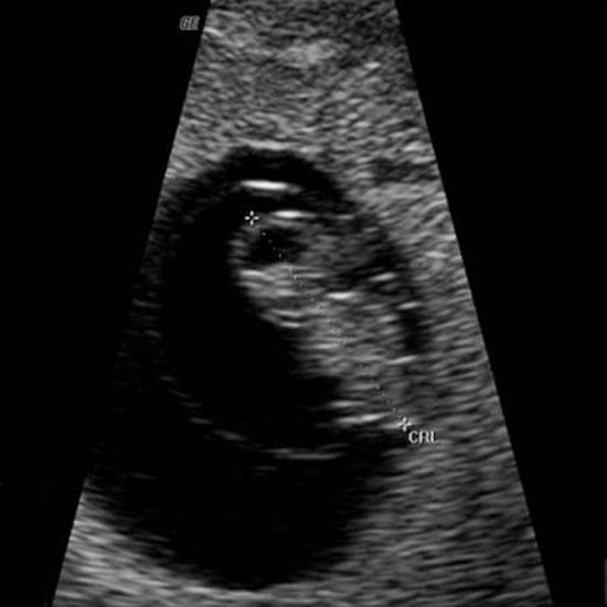Your Ultrasound in Week 7