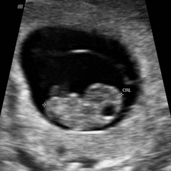 Your Ultrasound in Week 8