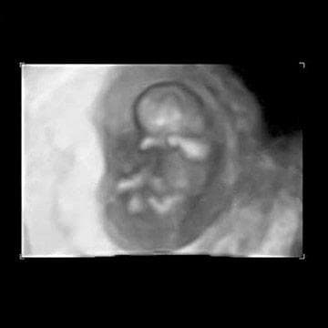 Your Ultrasound in Week 10