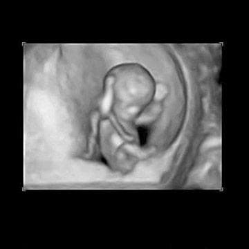 Your Ultrasound in Week 11