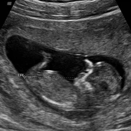 Your Ultrasound in Week 12
