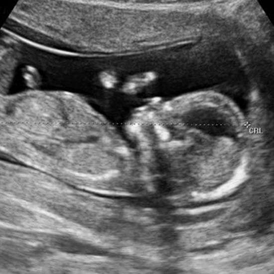 Your Ultrasound in Week 13