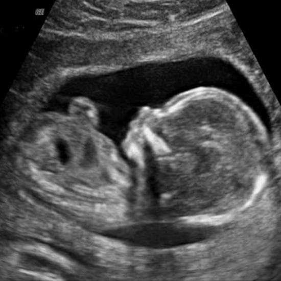 Your Ultrasound in Week 13