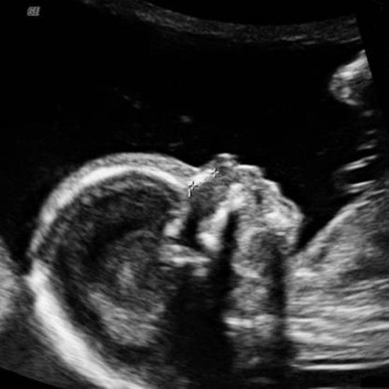 Your Ultrasound in Week 16