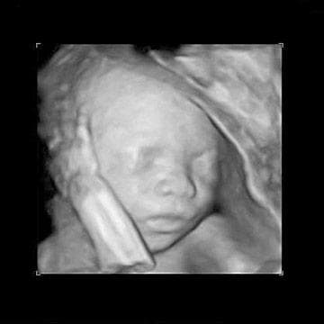 Your Ultrasound in Week 17