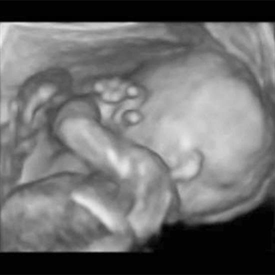 Your Ultrasound in Week 20