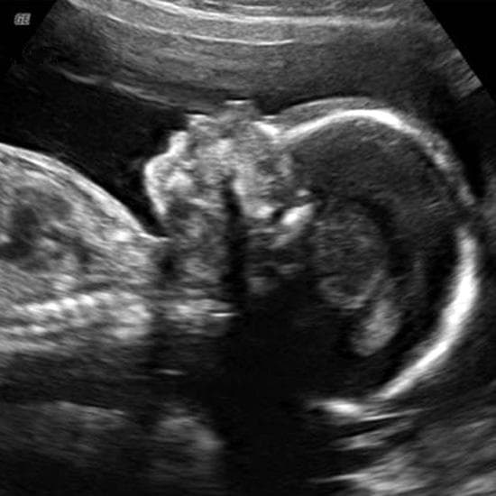Your Ultrasound in Week 20