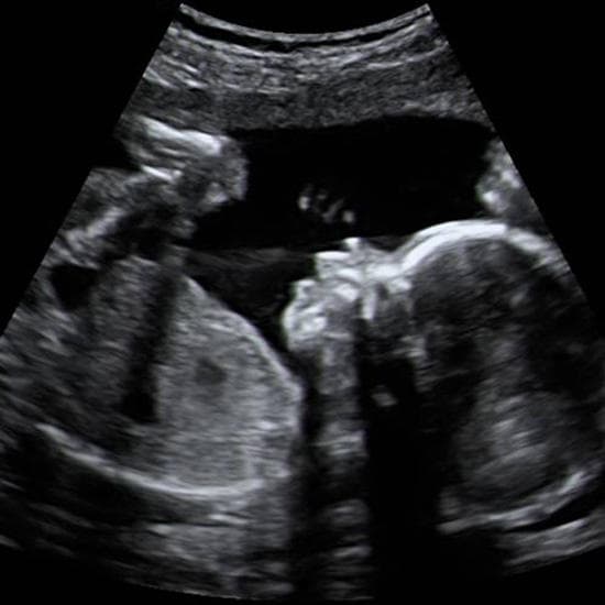 Your Ultrasound in Week 22