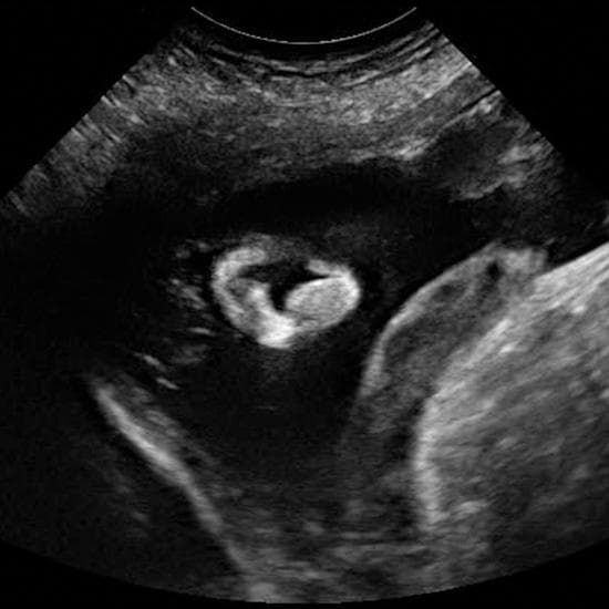 Your Ultrasound in Week 26