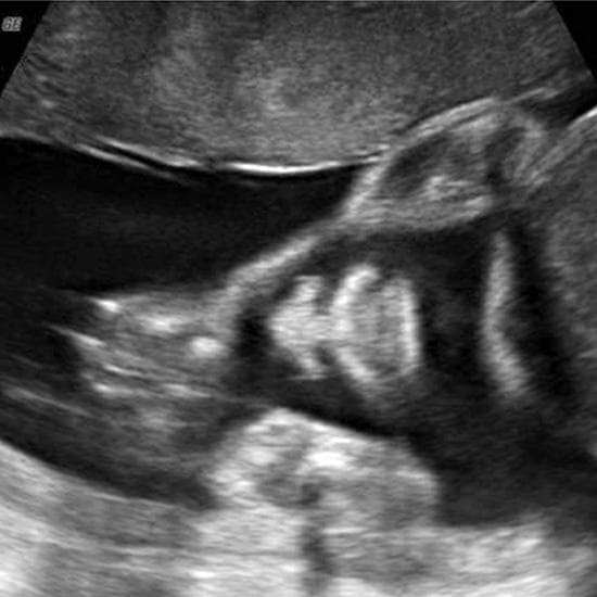 Your Ultrasound in Week 26