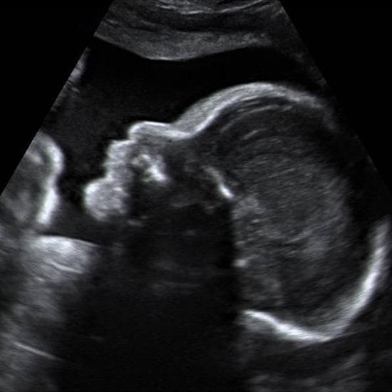 Your Ultrasound in Week 27