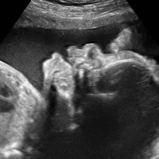 Your Ultrasound in Week 34