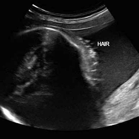 Your Ultrasound in Week 28