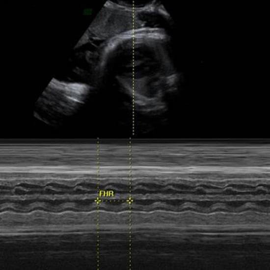 Your Ultrasound in Week 37