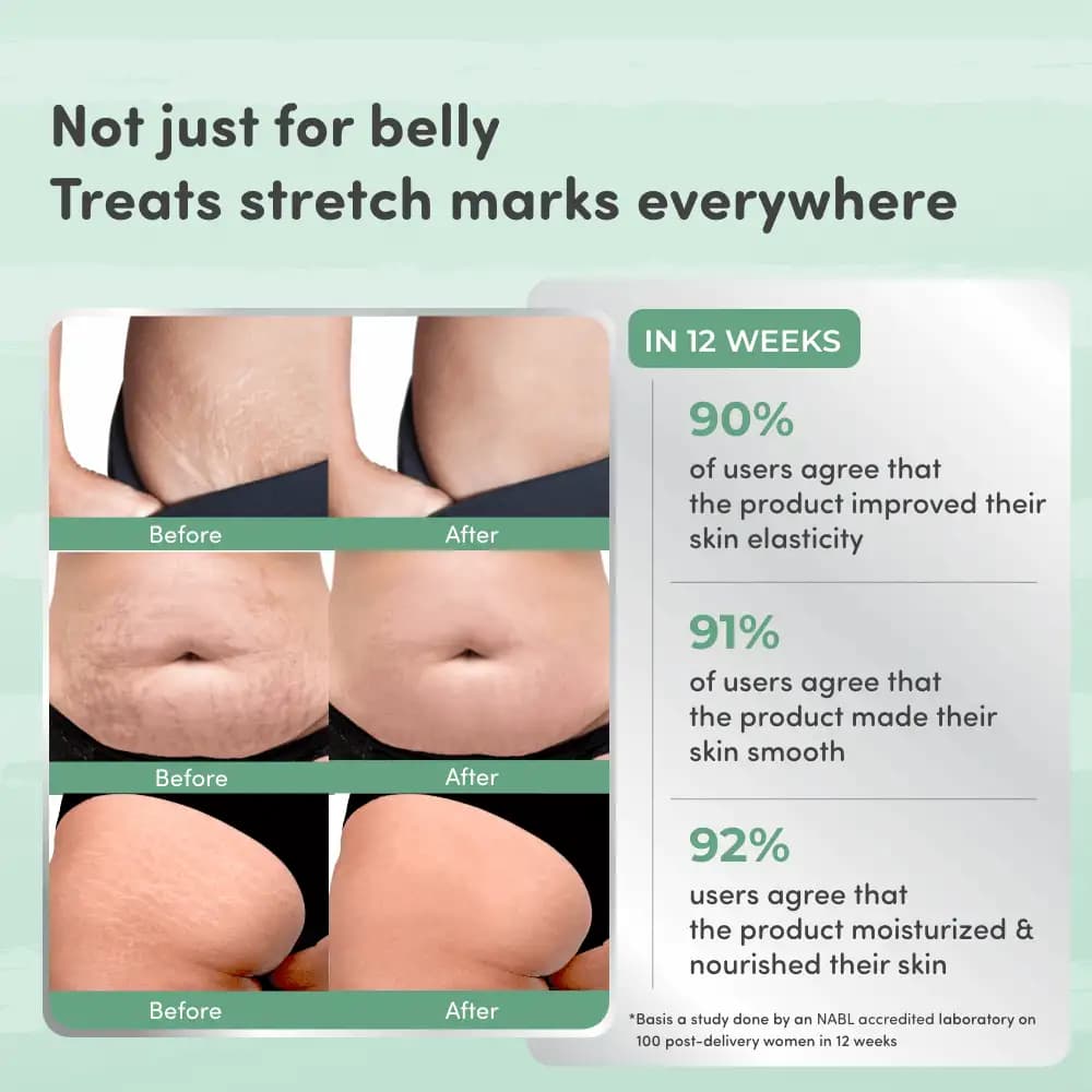Stretch Marks Kit - Removes Scars | Made with Natural Ingredients | Tightens Skin - (Stretch Mark Oil - 100 ml, Stretch Marks Cream - 100ml