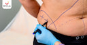 Images related to Tummy Tuck (Abdominoplasty) Procedure, Risks, Preparation & Recovery