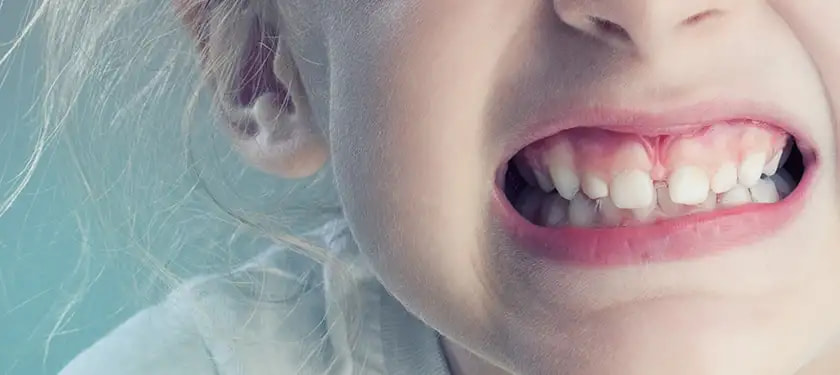 Causes of Bruxism (Teeth Grinding) in Kids