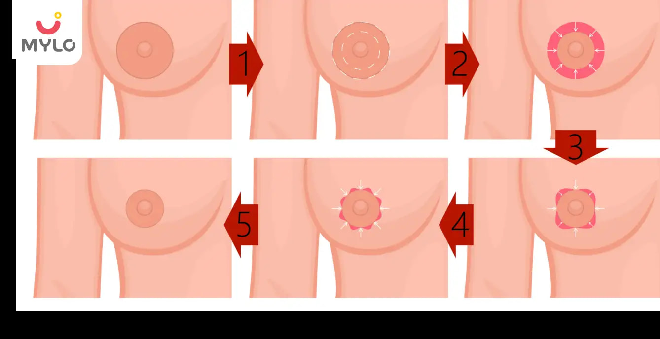 Big Areolas: A Comprehensive Guide to Causes, Risks and Treatments