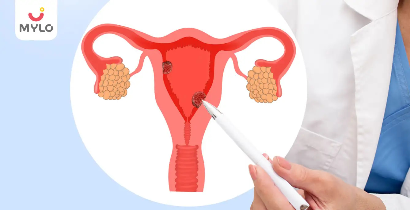 Endometrial Hyperplasia: The Ultimate Guide to Understanding Its Causes and Treatment 
