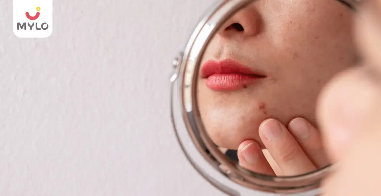 Home Remedies for PCOS Acne in Hindi | घरेलू उपाय से कैसे करें PCOS एक्ने को ठीक?