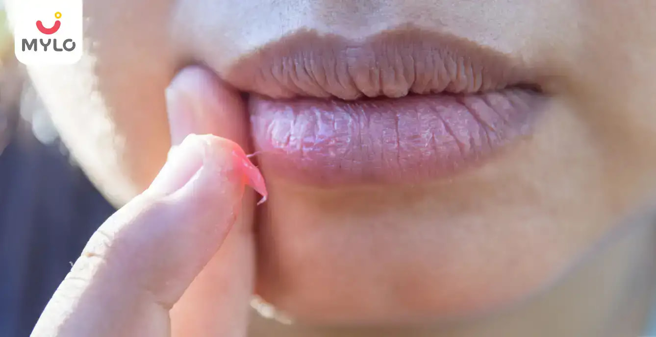 గర్భధారణ కాలంలో పెదవులు పొడిబారడం: లక్షణాలు ఇంకా కారణాలు (Lips Dry During Pregnancy: Symptoms and Causes in Telugu)