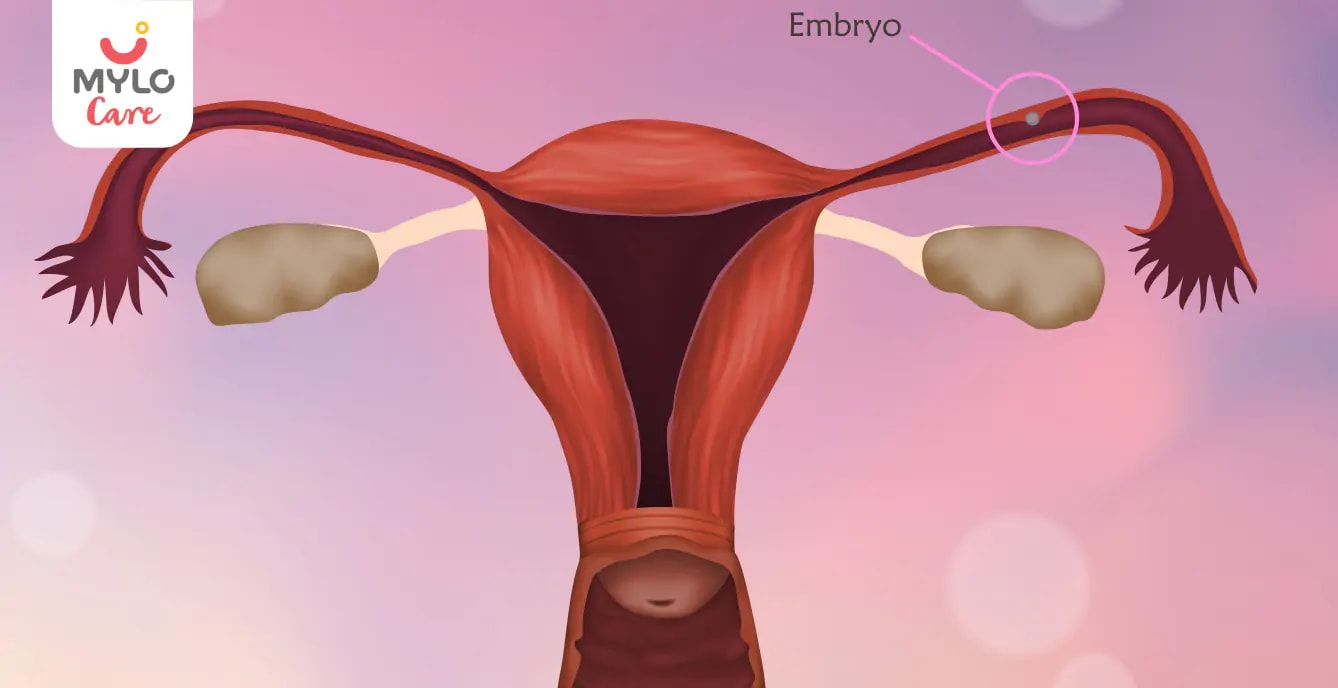 எக்டோபிக் பிரக்னன்ஸி அறிகுறிகள் எப்போது தொடங்குகின்றன I When do Ectopic Pregnancy Symptoms start in Tamil?